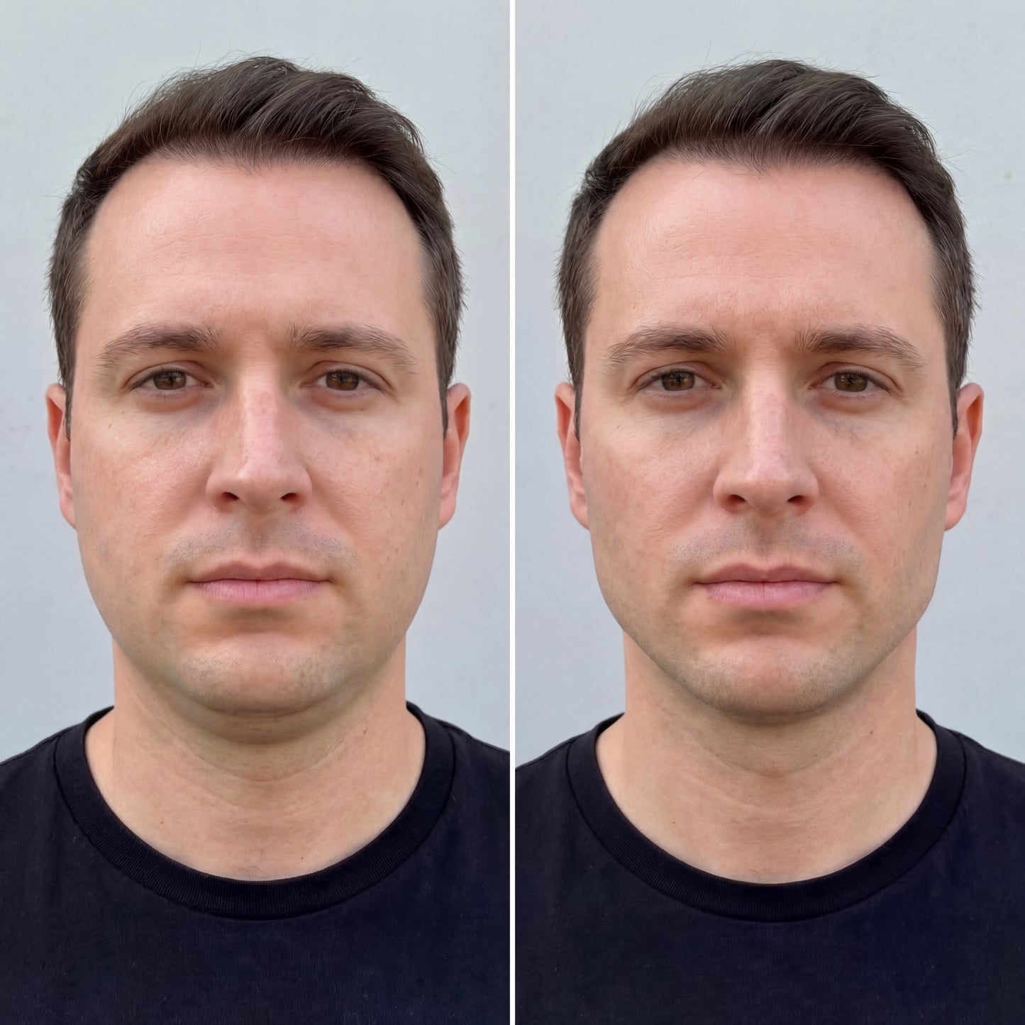 Jawline Compression Wrap