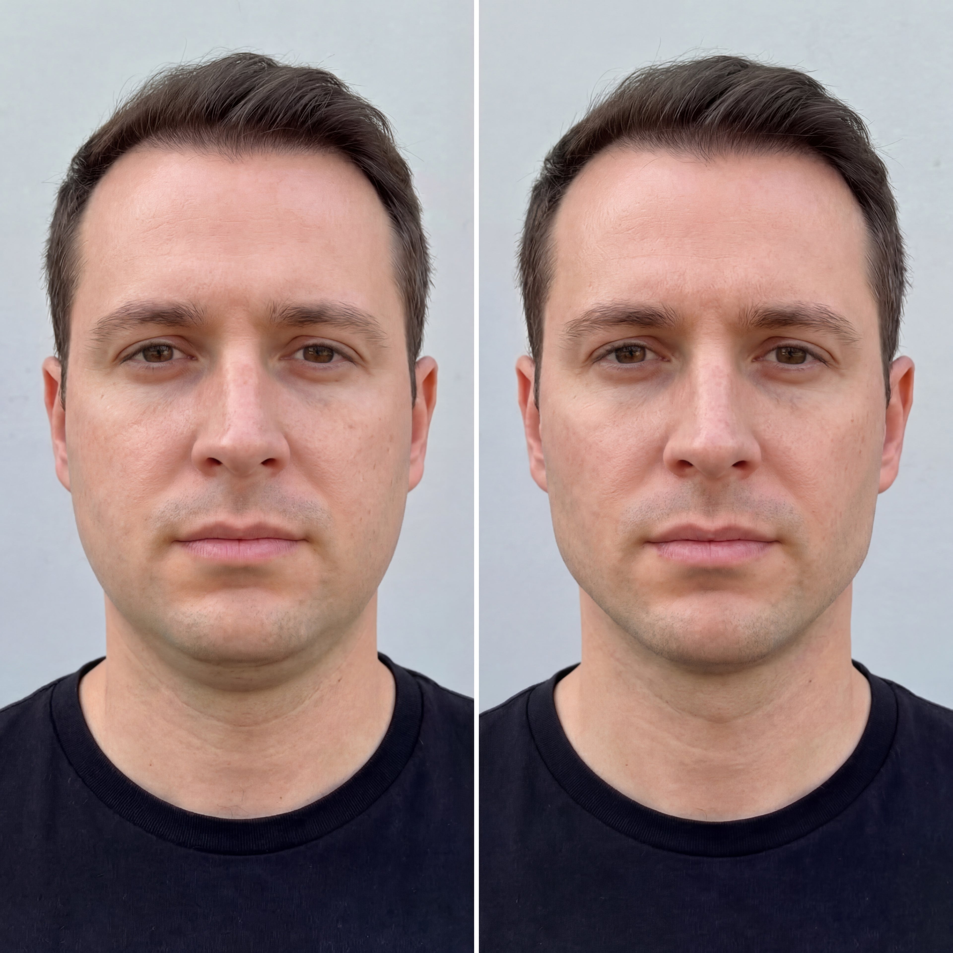 Jawline Compression Wrap